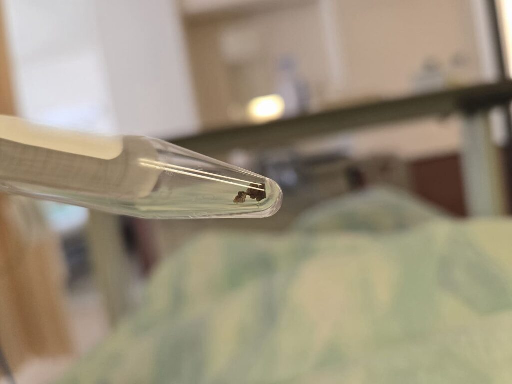 手術で取り除いた結石