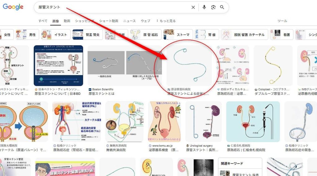 尿管ステントは本当に嫌でした